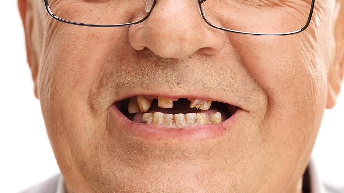 Senior man face closeup with missing teeth